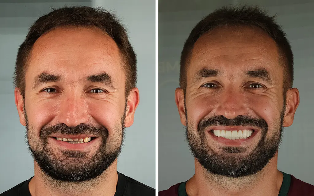 Patient with temporomandibular joint dysfunction and pathological tooth wear.