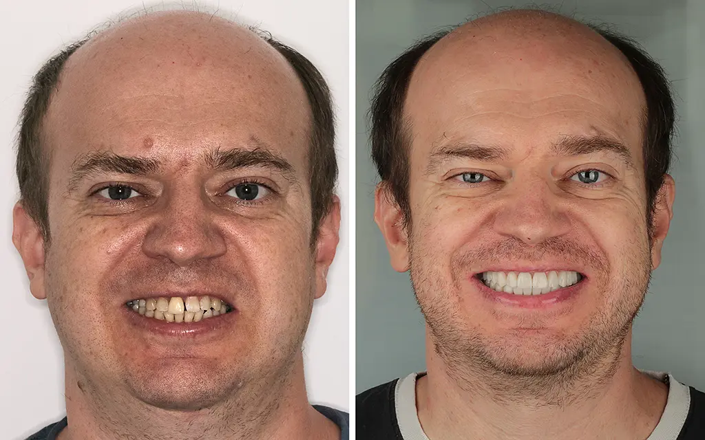 Comprehensive rehabilitation for temporomandibular joint dysfunction.